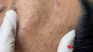 357 • Acne collection • АСМР • Relax Spa