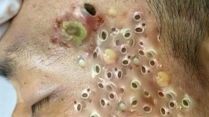 Extreme Blackhead Removal Satisfying Relaxing #1091
