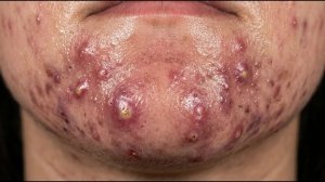 Loan Nguyen Acne Treatment 49ll