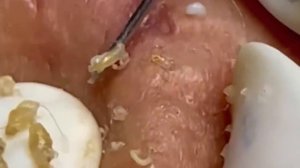 #1042 Чистка лица от угрей и акне. Выдавливание прыщей. Удаление черных точек и комедонов