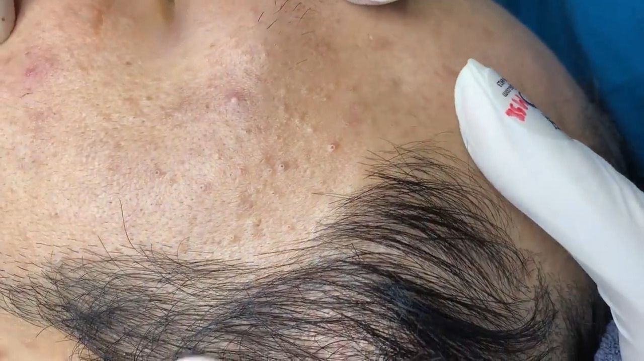 Acne Collection • A031 • Архив SacDepSpa • АСМР