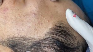 Acne collection • A031 • Архив SacDepSpa • АСМР