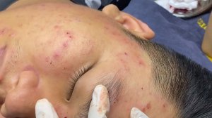 359 • Acne collection • АСМР • Relax Spa