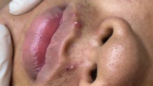 358 • Acne collection • АСМР • Relax Spa