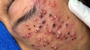 Blackhead Removal With Sac Dep Spa @511