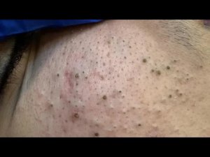 ASMR Korean Skincare Routine & Blackhead Extraction for Glowing Skin