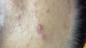 Чистка жирной кожи от Acne. Глубокая процедура