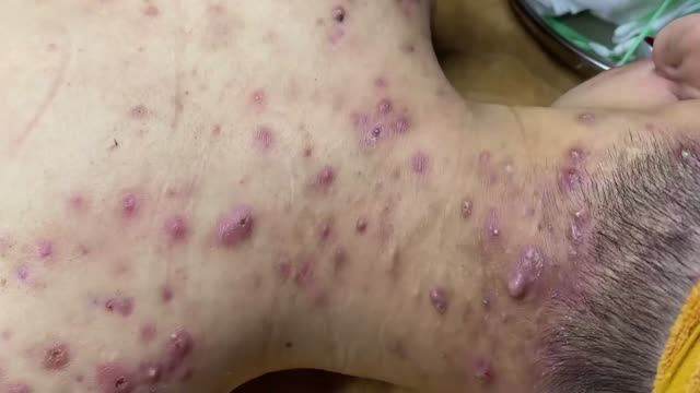 Очищение пор от acne. Механический метод смотреть онлайн