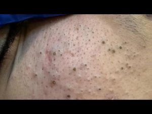 Уход за лицом от акне! Ретро-четверг: решения для кожи