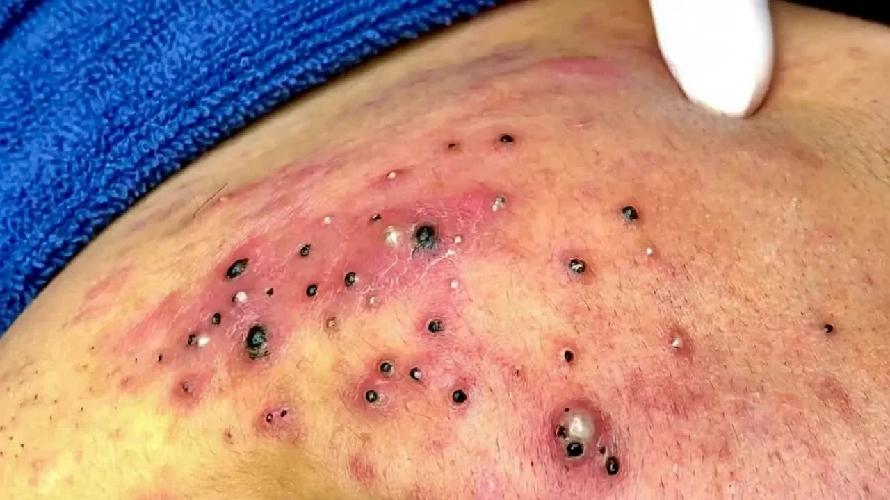 Удаление черных точек в Today Spa смотреть онлайн
