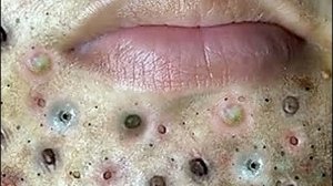 Удаление черных точек Отличное качество