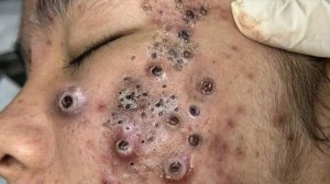 Удаление черных точек Отличное качество