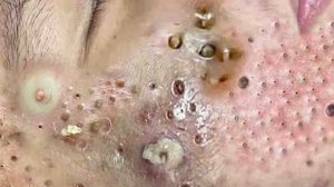 Удаление черных точек Отличное качество
