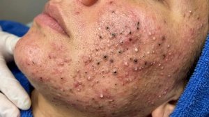 Удаление черных точек в Sac Dep Spa
