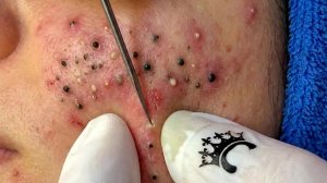 Удаление черных точек с Sac Dep Spa