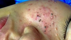 Удаление черных точек в Sac Dep Spa