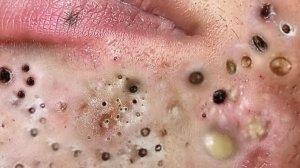 Удаление черных точек Отличное качество