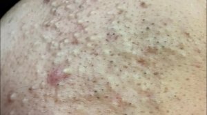 Лучшее средство от черных точек