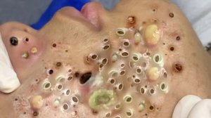 Удаление черных точек Отличное качество