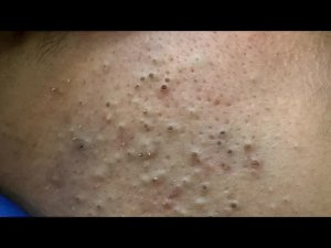 Deep Dive into Blackheads part 1. Expert Facial Care Routine for Clear Skin!