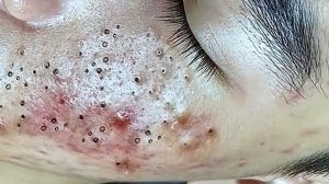 Выдавливание прыщей. Отличное качеств