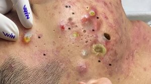 Экстремальное удаление черных точек: удовлетворяющее и расслабляющее