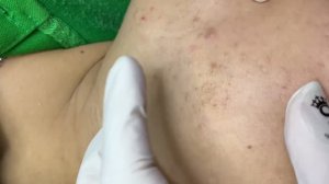 Удаление комедонов на шее и подбородке