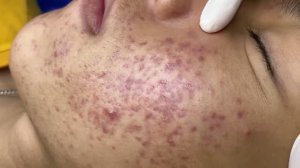 Удаление воспаленных прыщей на лице