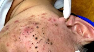 Удаление черных точек с Sac Dep Spa @904