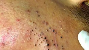 Удаление черных точек с Sac Dep Spa