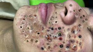 Удаление черных точек Отличное качество