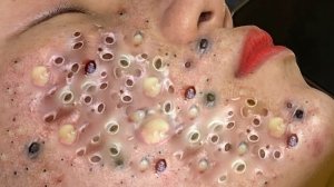 Выдавливание прыщей. Отличное качеств