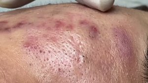 Удаление прыщей и открытых комедонов