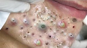 Выдавливание прыщей. Отличное качеств