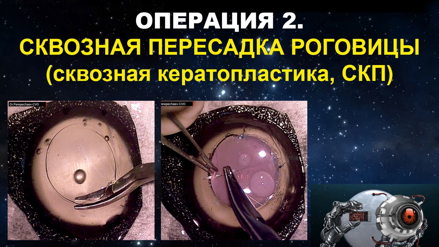 ГЛАЗ-ТРЕНАЖЕР. Операция 2. Сквозная пересадка роговицы (сквозная кератопластика, СКП)