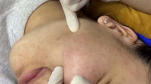 Удаление прыщей у косметолога — полный процесс