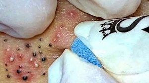Удаление черных точек с Sac Dep Spa