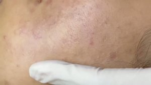 Удаление множественных комедонов на лице