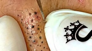 Удаление черных точек в Sac Dep Spa