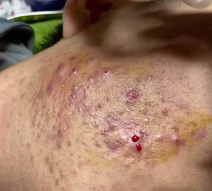 Удаление прыщей и комедонов. Чистка лица