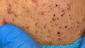 Удаление черных точек с Sac Dep Spa