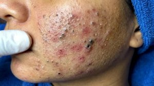 Удаление черных точек в Sac Dep Spa