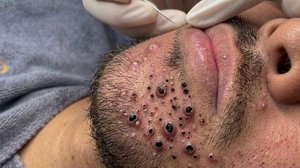 Удаление черных точек Отличное качество
