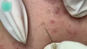 #643 Удаление акне. Экстракция комедонов. Подкожные прыщи. Чистка от черных точек