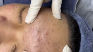 365 • Acne collection • АСМР • Relax Spa