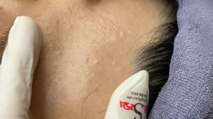 364 • Acne collection • АСМР • Relax Spa