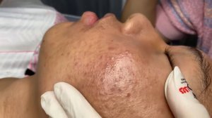 362 • Acne collection • АСМР • Relax Spa