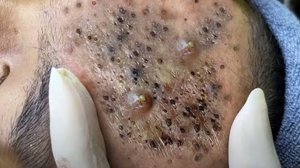 Выдавливание прыщей. Отличное качеств