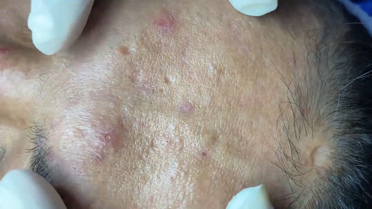Acne Collection • A033 • Архив SacDepSpa • АСМР