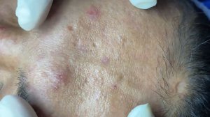 Acne collection • A033 • Архив SacDepSpa • АСМР